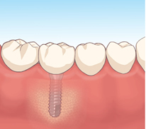 implant_01.jpg